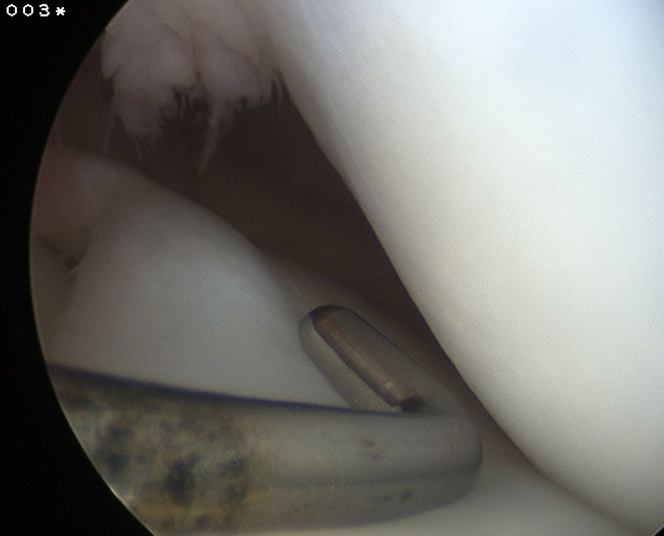 Complete discoid meniscus 2